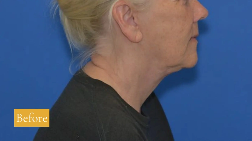 Facelift - Patient 4 (after)