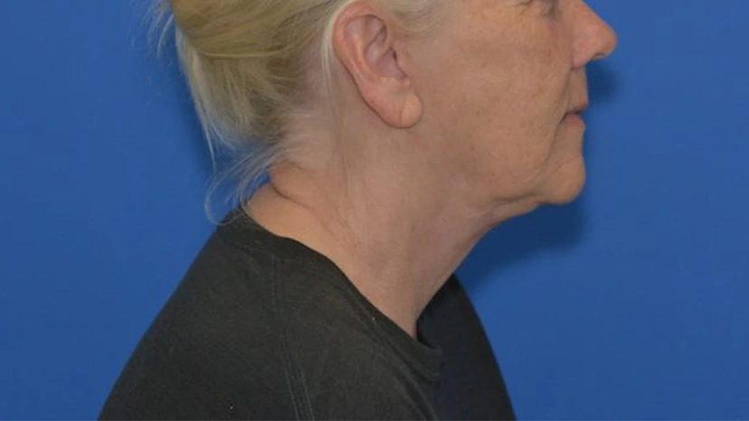 Facelift - Patient 4 (after)