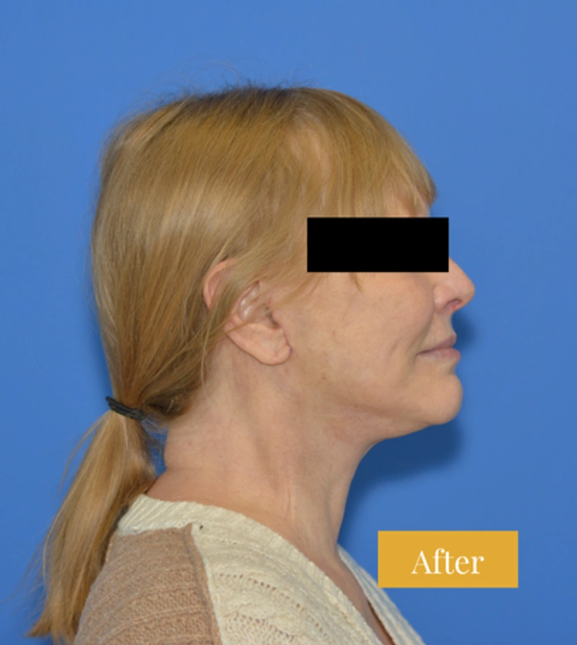 Neck Lift - Patient 1 - Set 1 - After