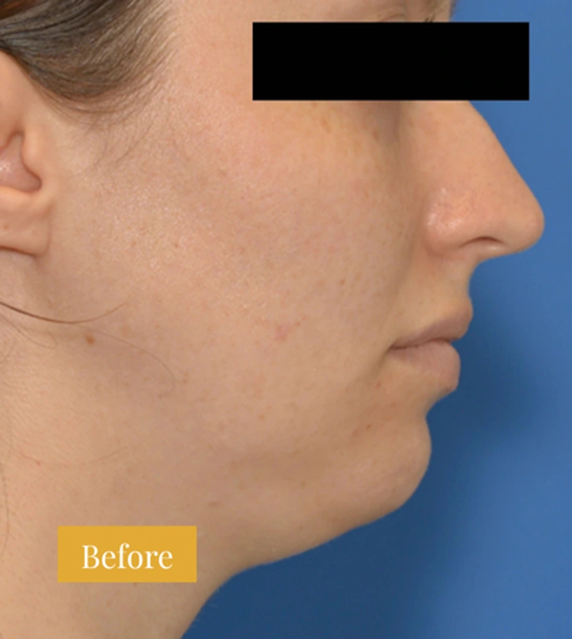 Rhinoplasty - Patient 9 - Set 1 - Before