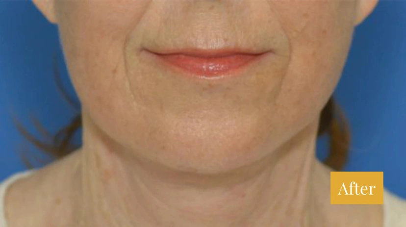 Facelift - Patient 11 - Set 1 - After