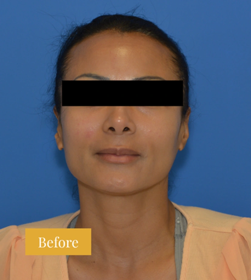 Eyebrow Lift - Patient 3 - Set 1 - Before