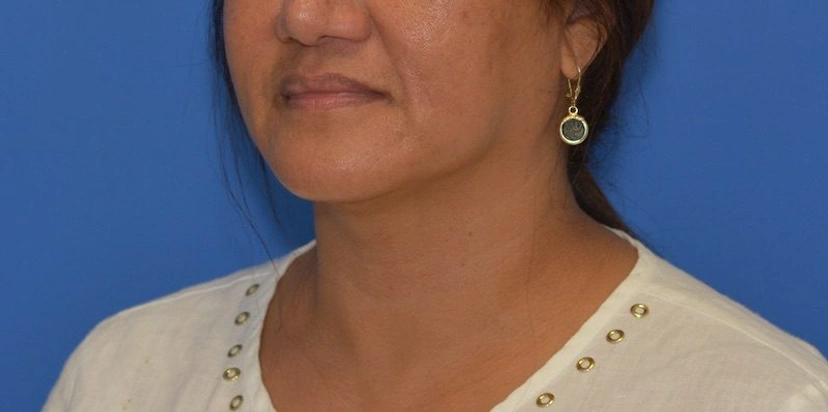 Morpheus8 RF Microneedling - Patient 3 (after)