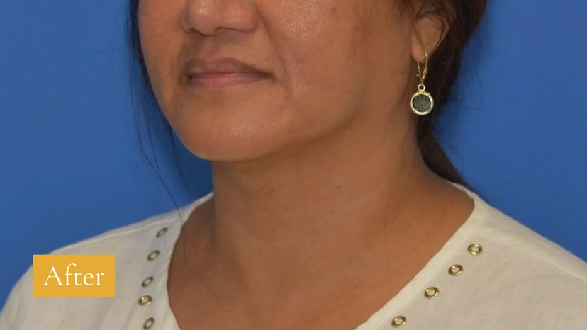 Morpheus8 RF Microneedling - Patient 3 (after)