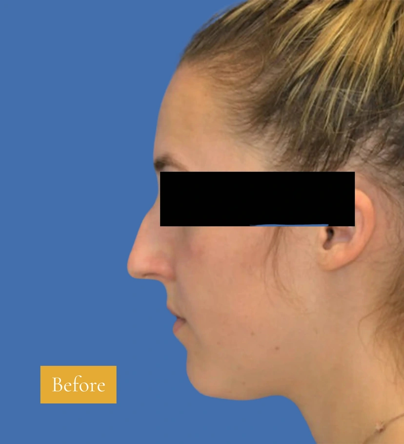 Rhinoplasty - Patient 5 (before)