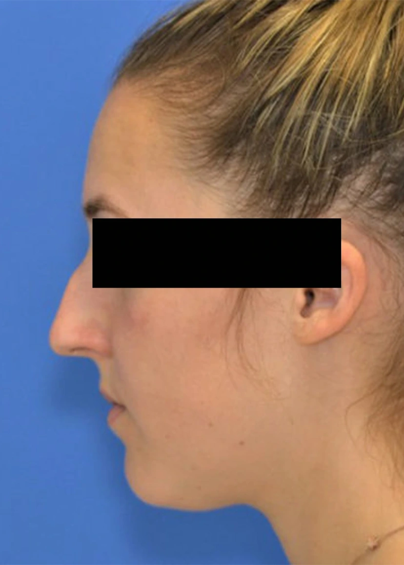 Rhinoplasty - Patient 5 (before)