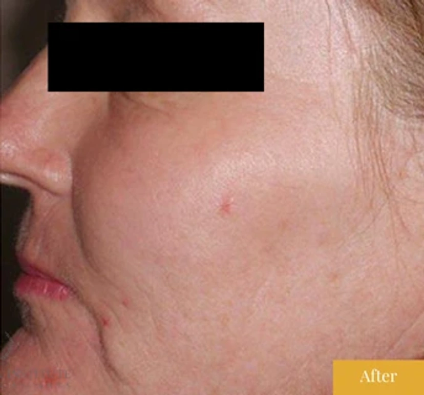 Fraxel - Patient 1 (after)