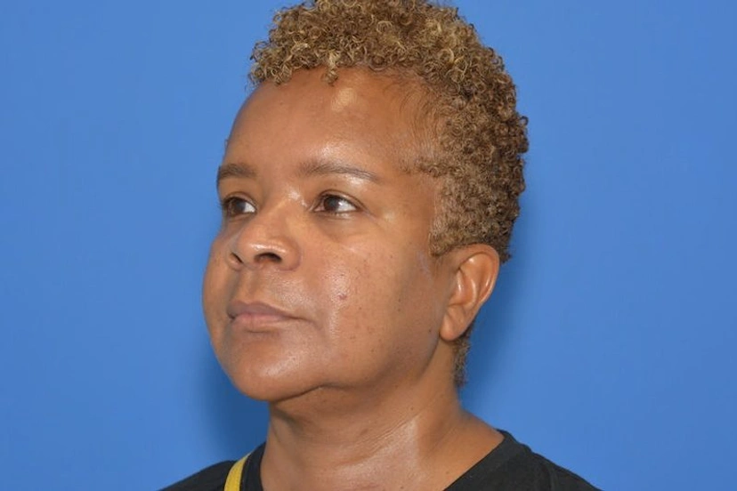 Morpheus8 RF Microneedling - Patient 8 (before)