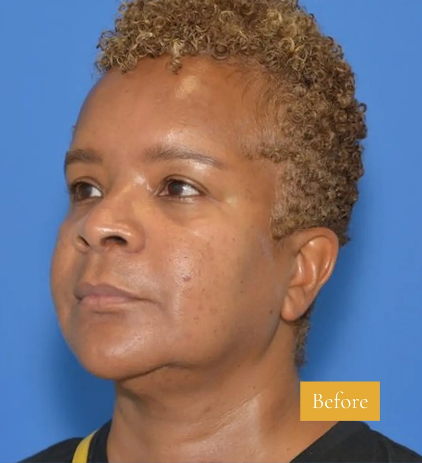 Morpheus8 RF Microneedling - Patient 8 (before)