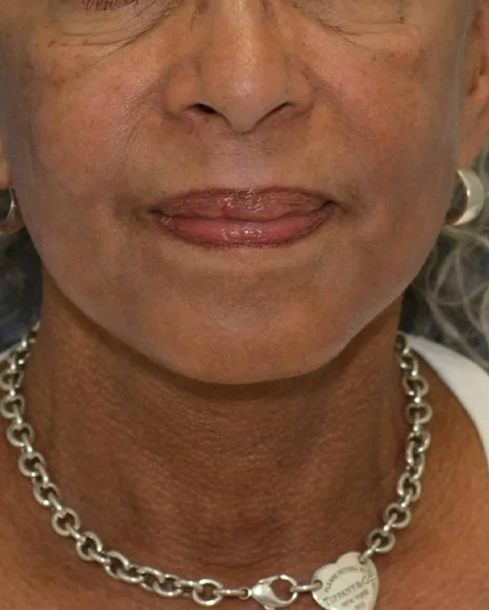 After Facelift before and after