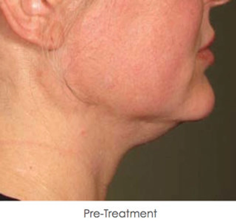 Ultherapy patient 2 result photo