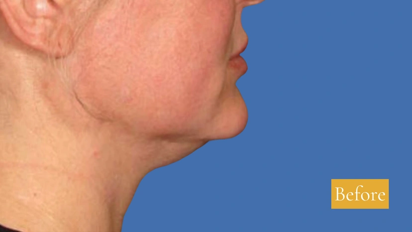 Ultherapy patient 2 result photo