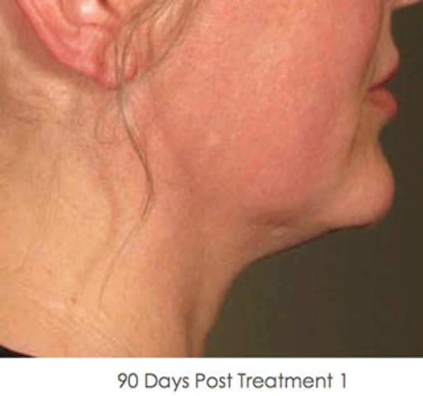 Ultherapy patient 2 result photo