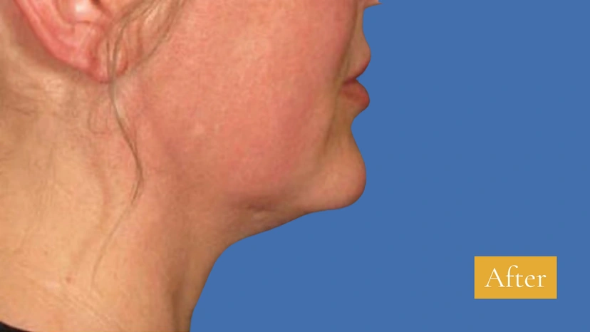 Ultherapy patient 2 result photo
