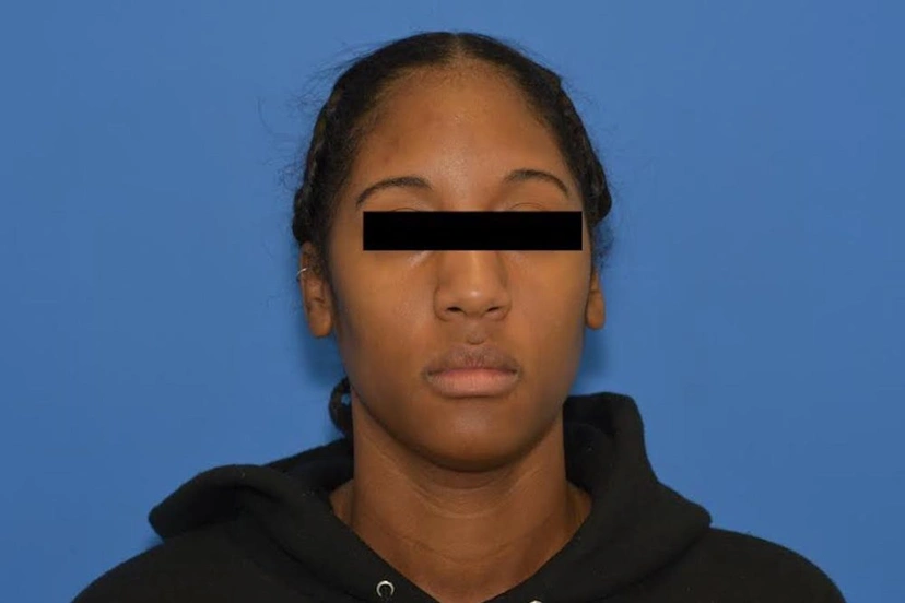 Microneedling - Patient 3 (after)