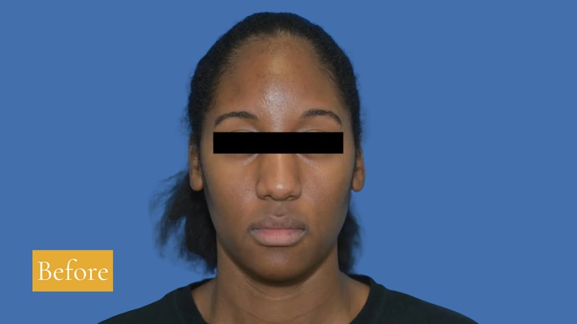 Microneedling - Patient 3 (after)