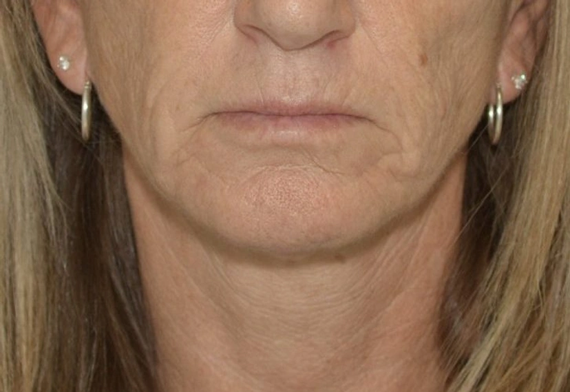 Morpheus8 RF Microneedling - Patient 4 (before)