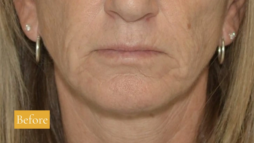 Morpheus8 RF Microneedling - Patient 4 (before)