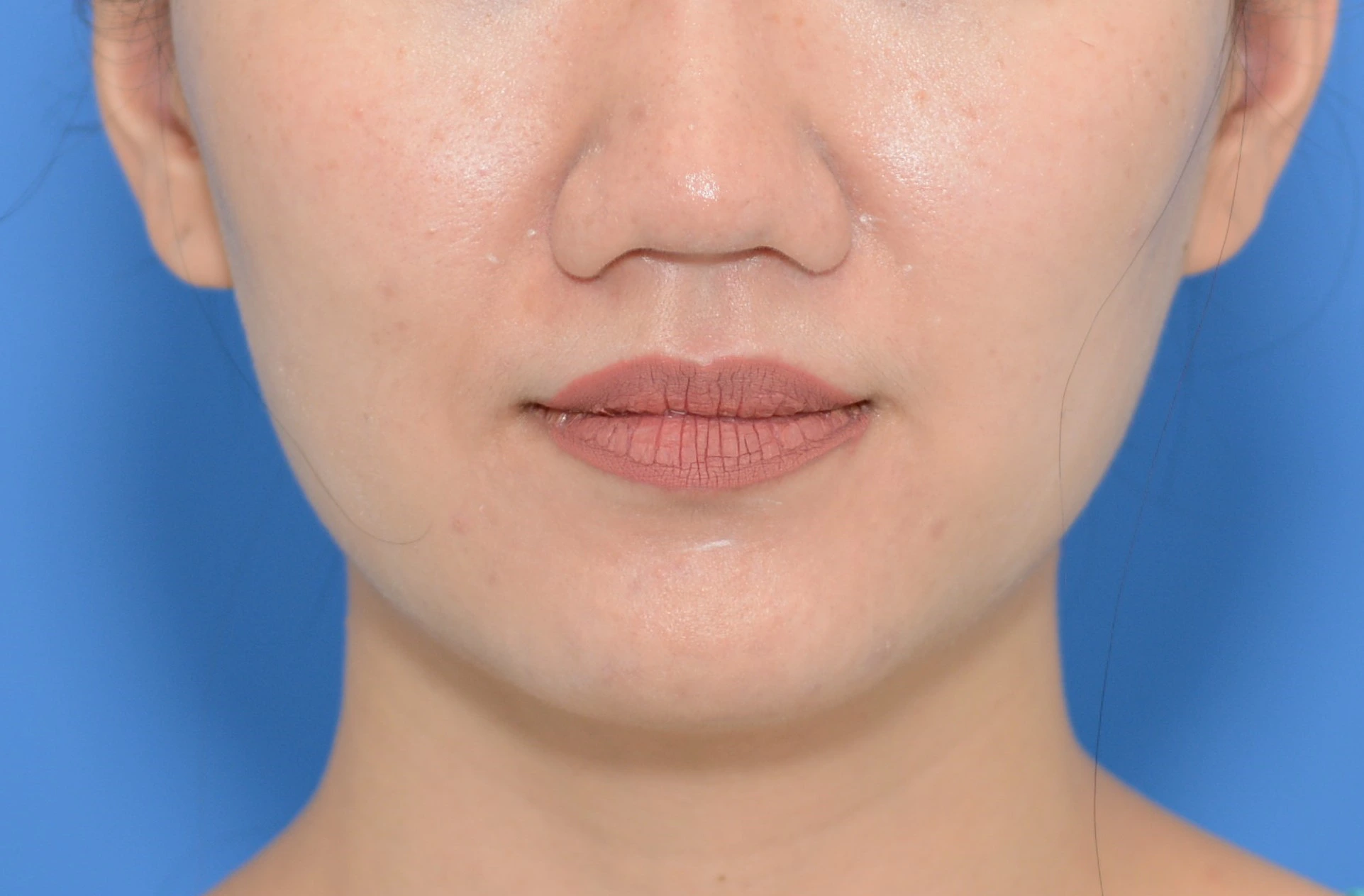 After BOTOX before and after
