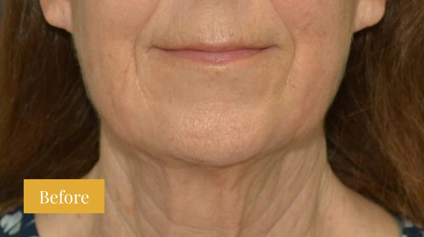 Facelift - Patient 11 - Set 1 - Before