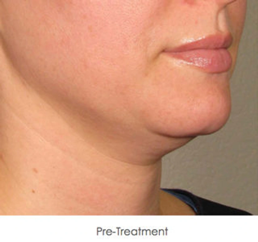 Ultherapy patient 1 result photo