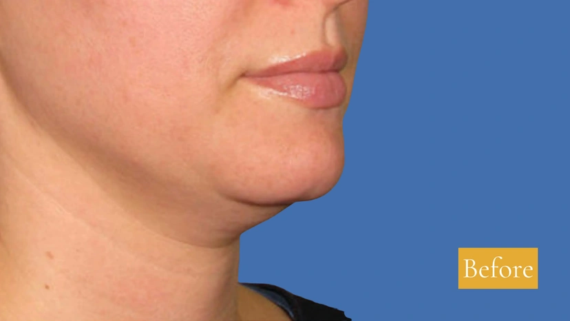 Ultherapy patient 1 result photo