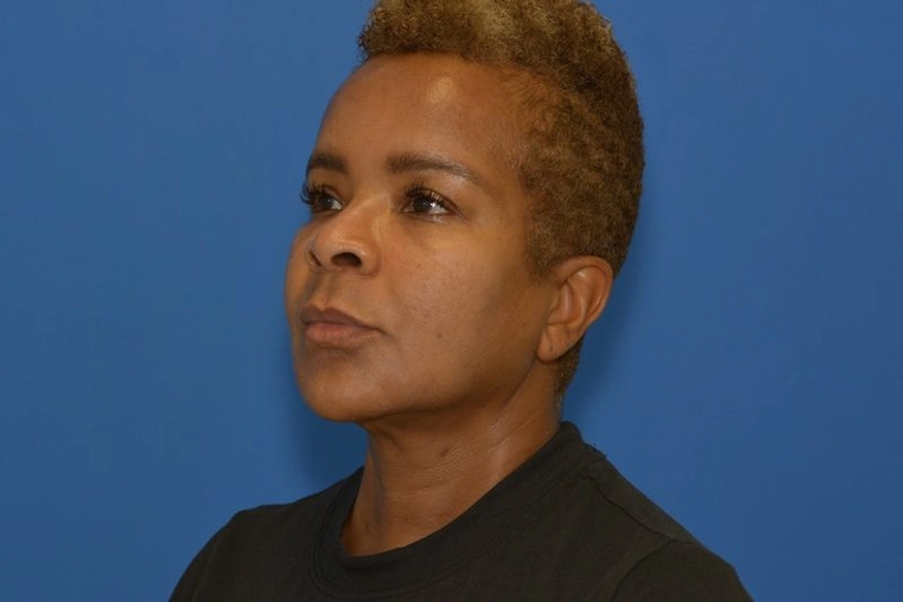 Morpheus8 RF Microneedling - Patient 8 (after)