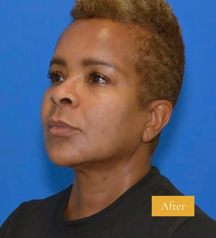 Morpheus8 RF Microneedling - Patient 8 (after)