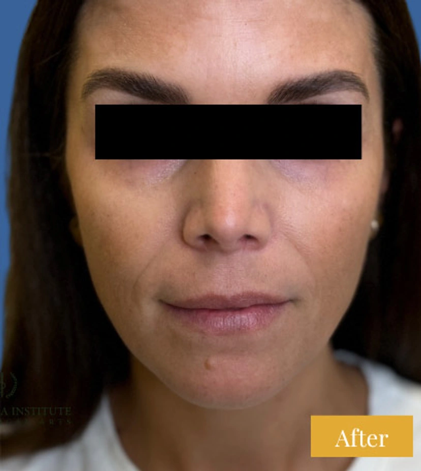 Sculptra - Patient 2 - Set 1 - After