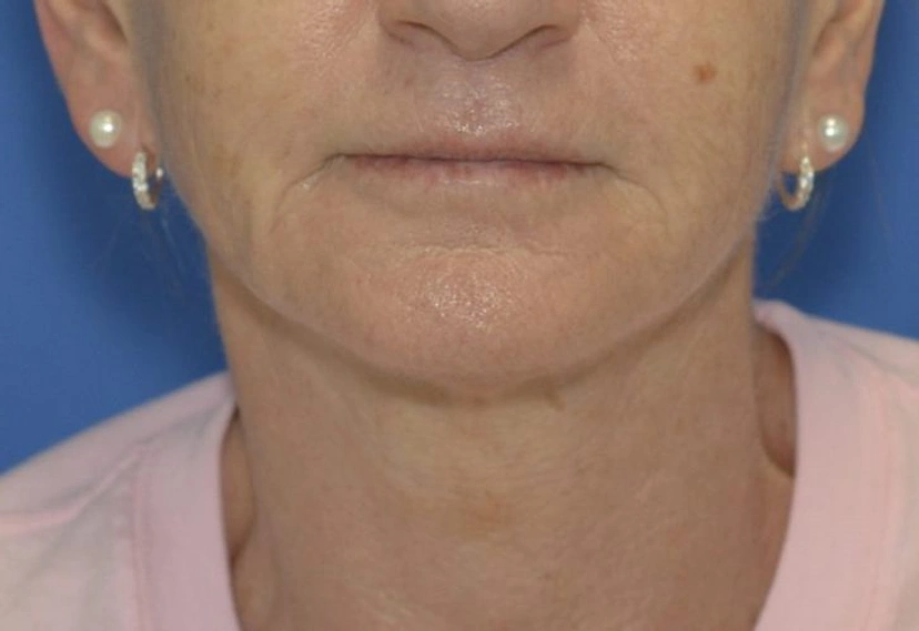 Morpheus8 RF Microneedling - Patient 4 (after)