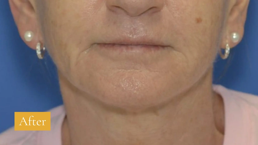 Morpheus8 RF Microneedling - Patient 4 (after)