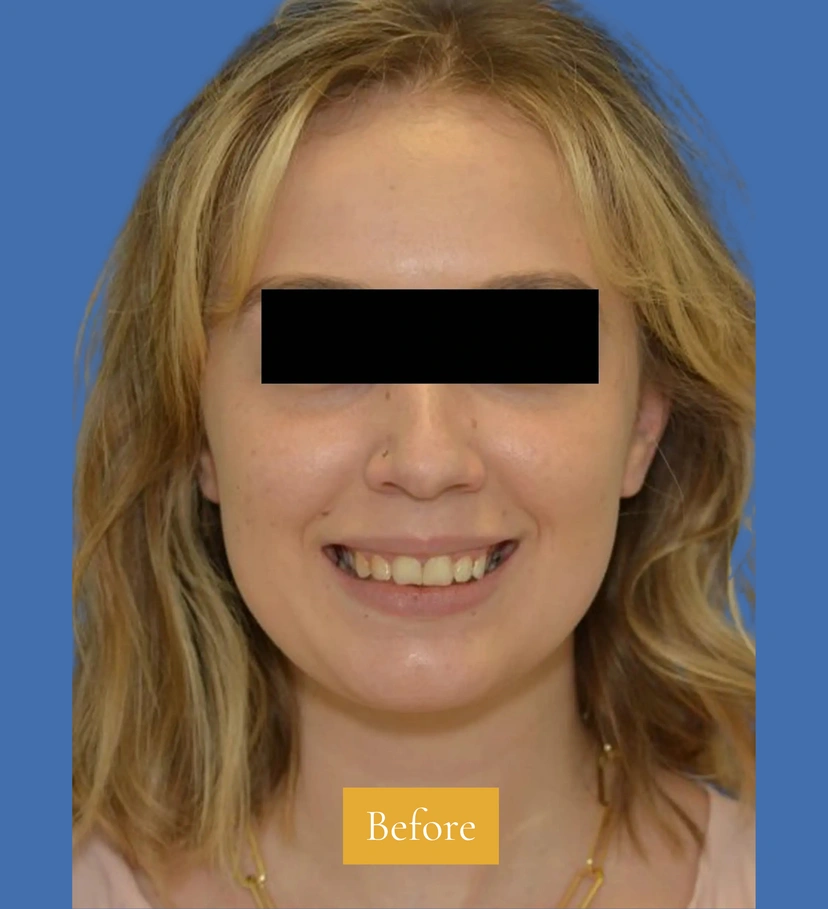 Botox - Patient 2 (front view before)