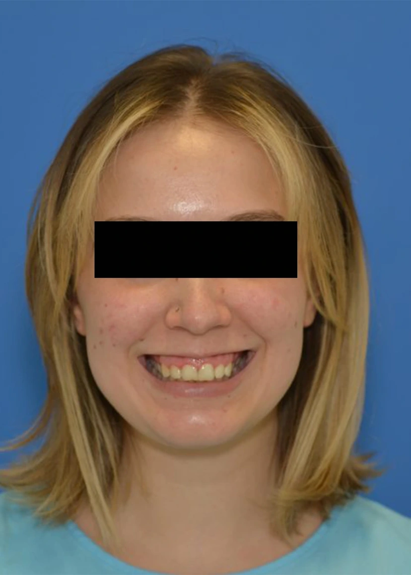 Botox - Patient 2 (front view before)