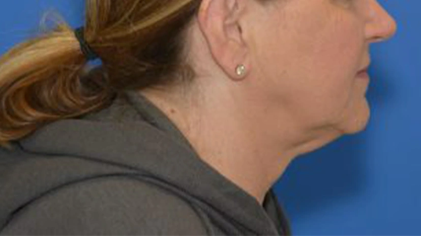 Facelift - Patient 1 (side view before)