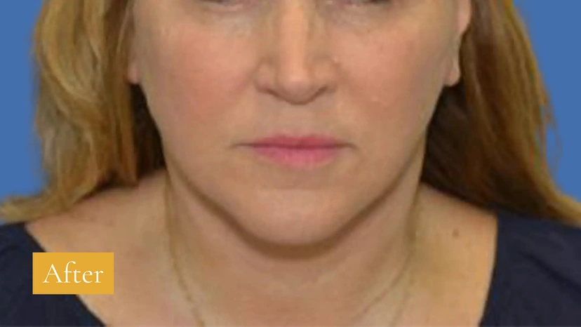Facelift - Patient 1 (front view before)