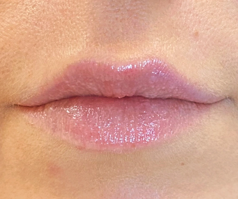 Dermal Fillers - Patient 3 (after)