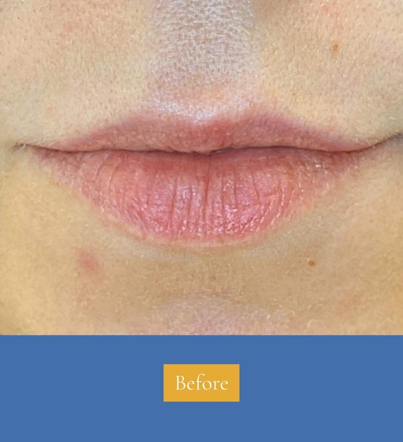 Dermal Fillers - Patient 3 (after)