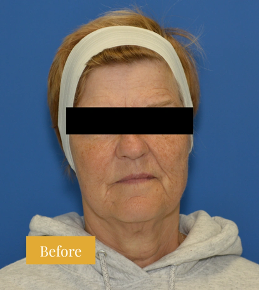 Eyebrow Lift - Patient 4 - Set 1 - Before