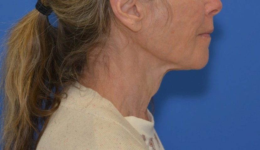 Morpheus8 RF Microneedling - Patient 2 (right side view after)