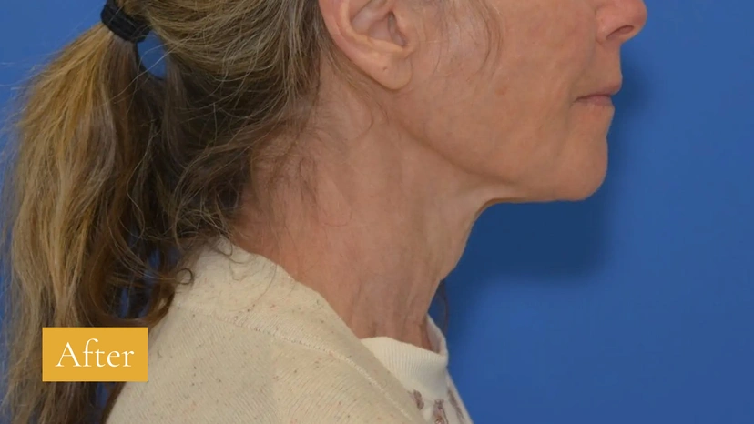 Morpheus8 RF Microneedling - Patient 2 (right side view after)
