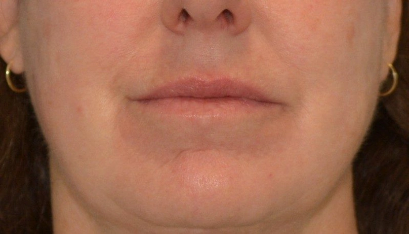 CO2 - Patient 1 (after)