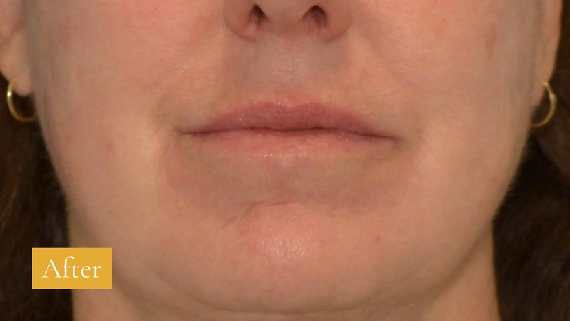 CO2 - Patient 1 (after)