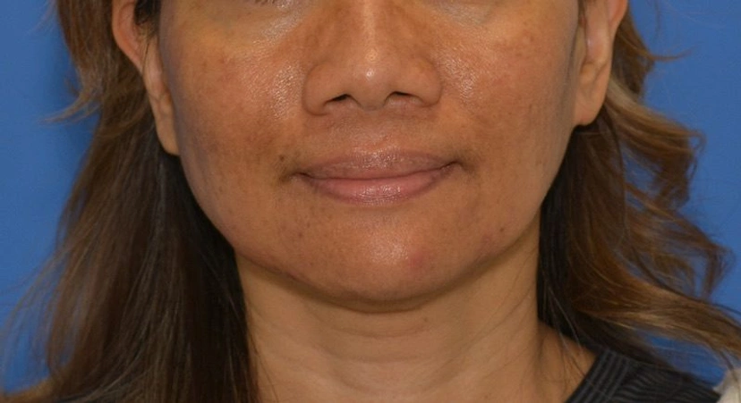 Microneedling - Patient 4 (before)