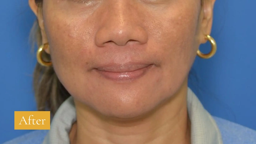 Microneedling - Patient 4 (before)