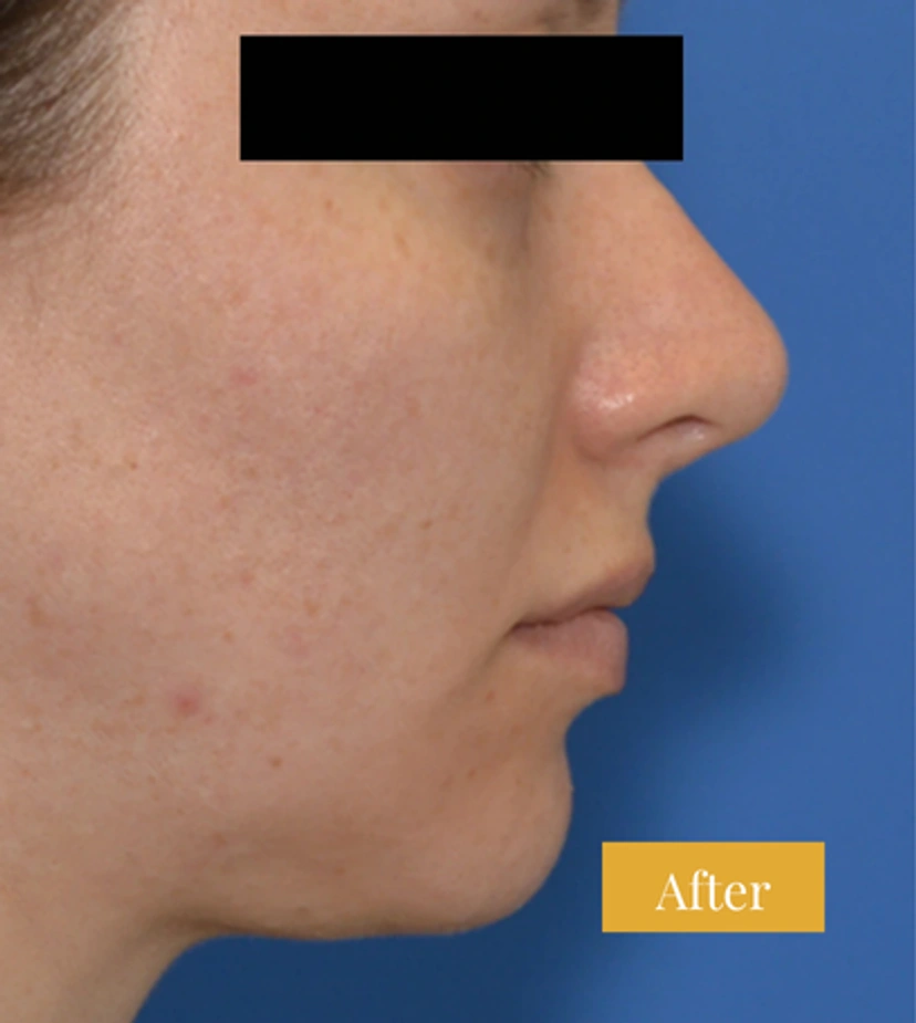 Rhinoplasty - Patient 9 - Set 1 - After