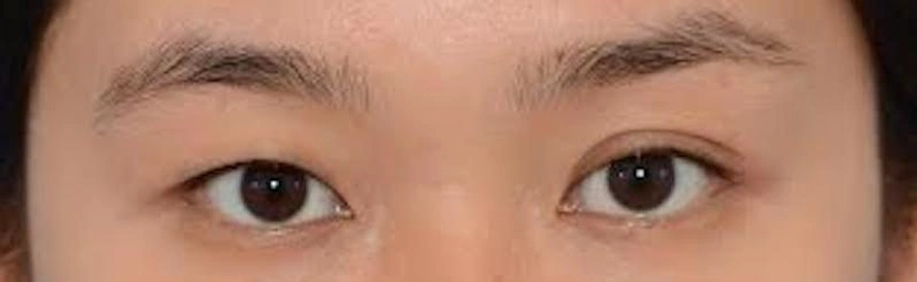 Asian eyelid surgery patient 62 result photo