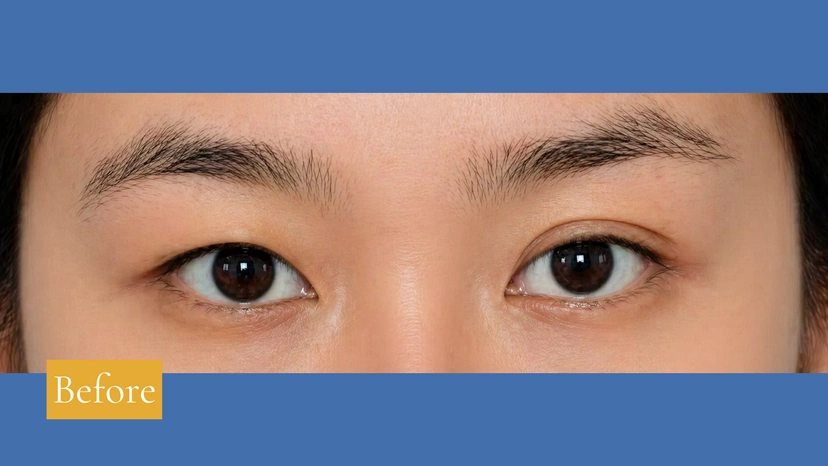 Asian eyelid surgery patient 62 result photo