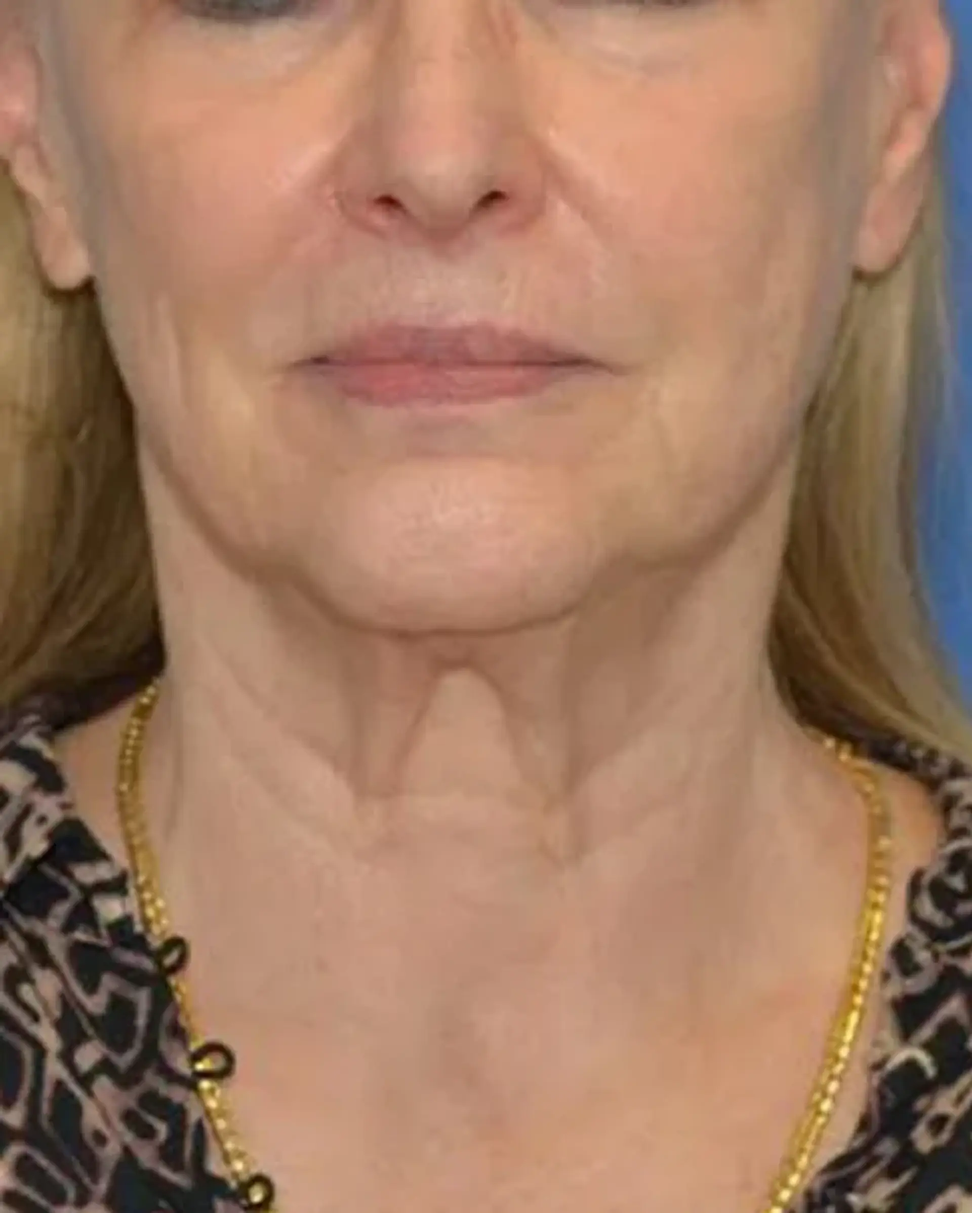 Before Facelift before and after
