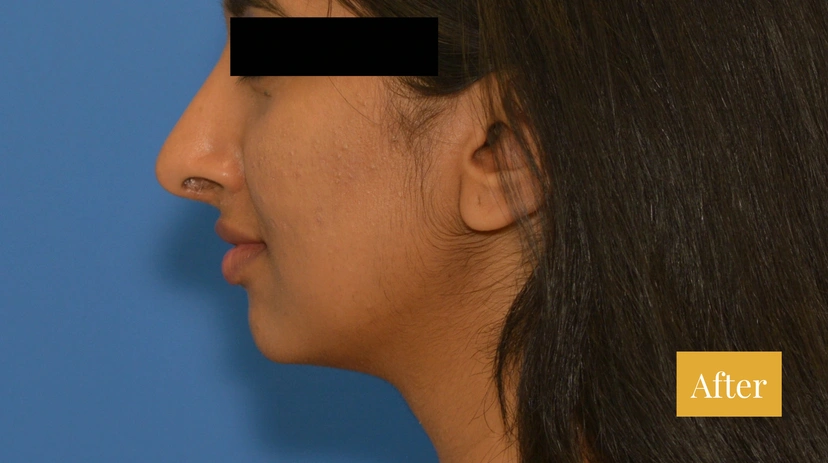 Rhinoplasty - Patient 10 - Set 1 - After