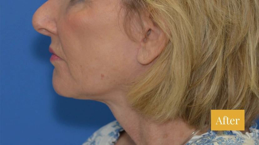 Facelift - Patient 9 - Set 1 - After